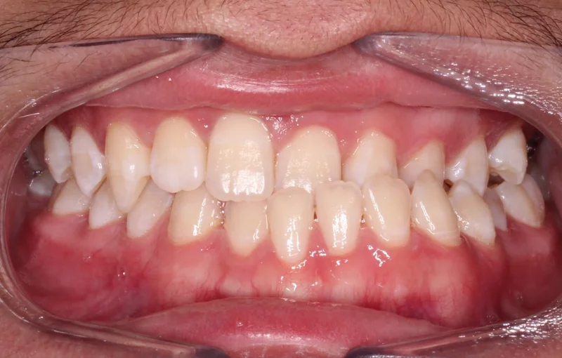 Center - Before Treatment