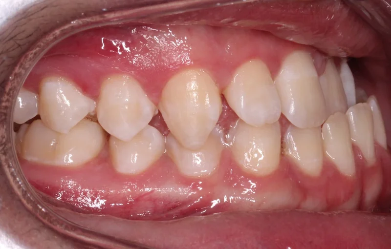Right Buccal - Before Treatment