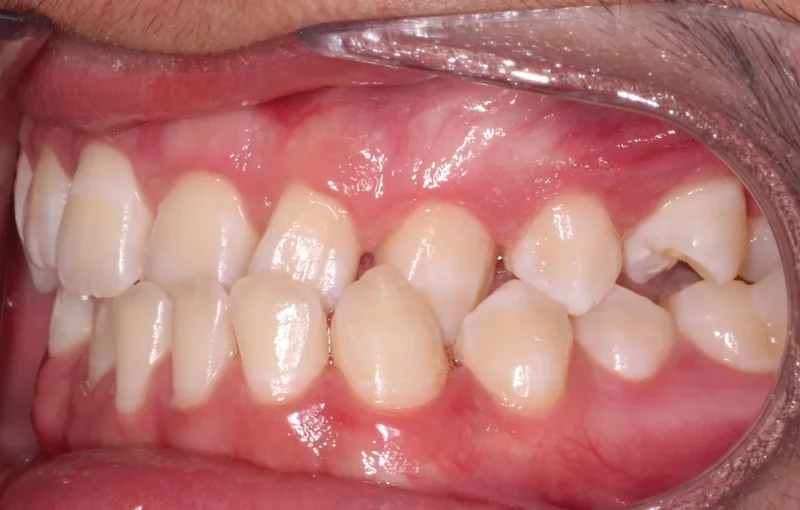 Left Buccal - Before Treatment