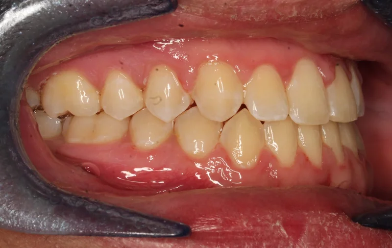 Right Buccal - After Treatment
