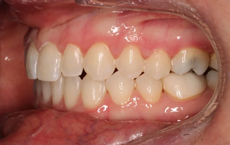 Left Buccal - After Treatment
