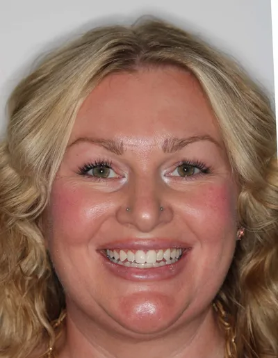 After Clear Braces treatment - Case 86915