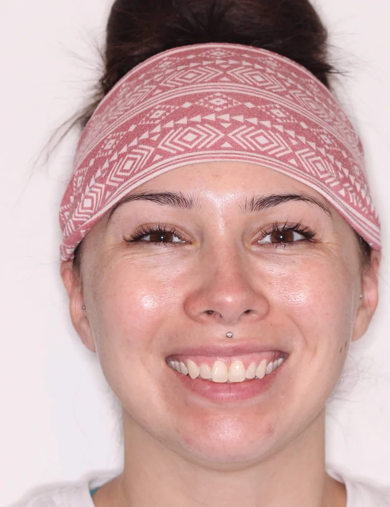 Facial Frontal Smiling - Before Treatment