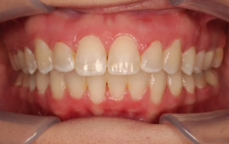 Center - After Treatment