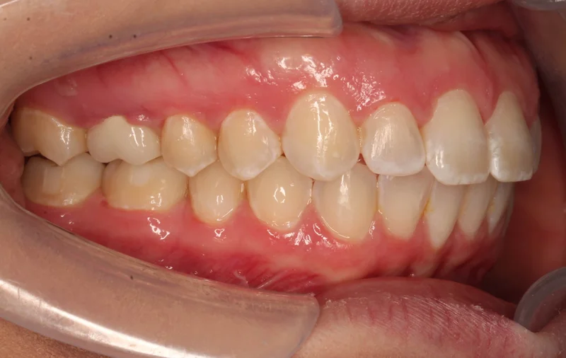 Right Buccal - After Treatment