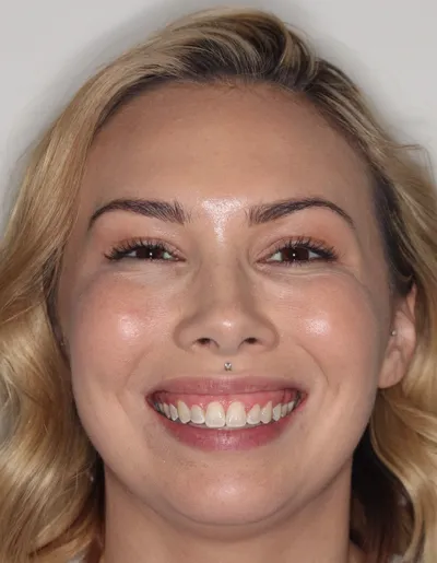 After Metal Braces treatment - Case 86921