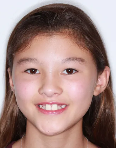 Before Metal Braces treatment - Case 87299