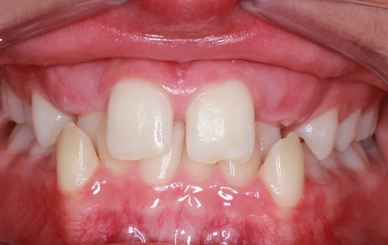 Center Bite - Before Treatment