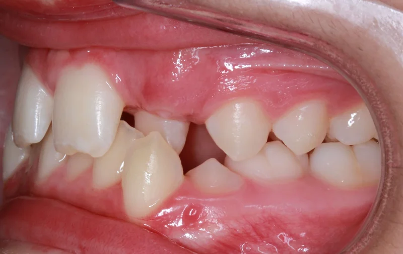Left Buccal - Before Treatment
