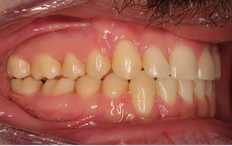 Right Buccal - After Treatment