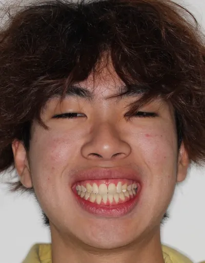 After Metal Braces treatment - Case 87773