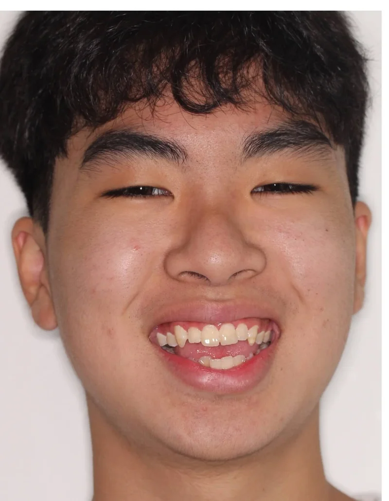 Facial Frontal Smiling - Before Treatment