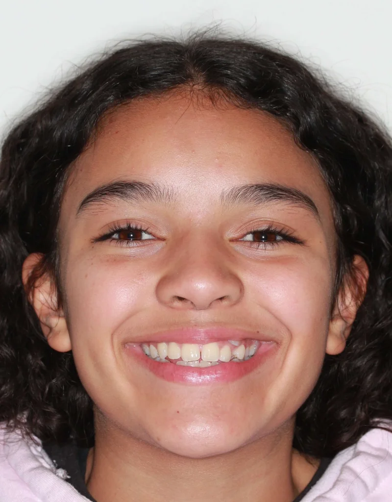 Facial Frontal Smiling - Before Treatment