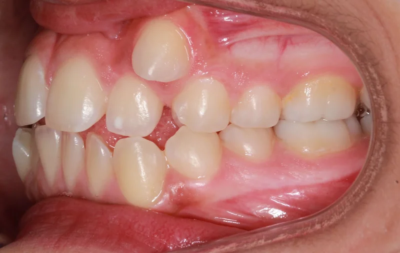 Left Buccal - Before Treatment