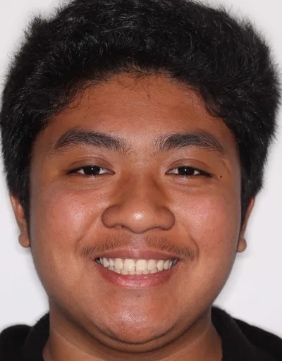 Before Metal Braces treatment - Case 87783