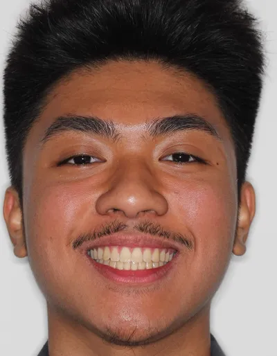 After Metal Braces treatment - Case 87783