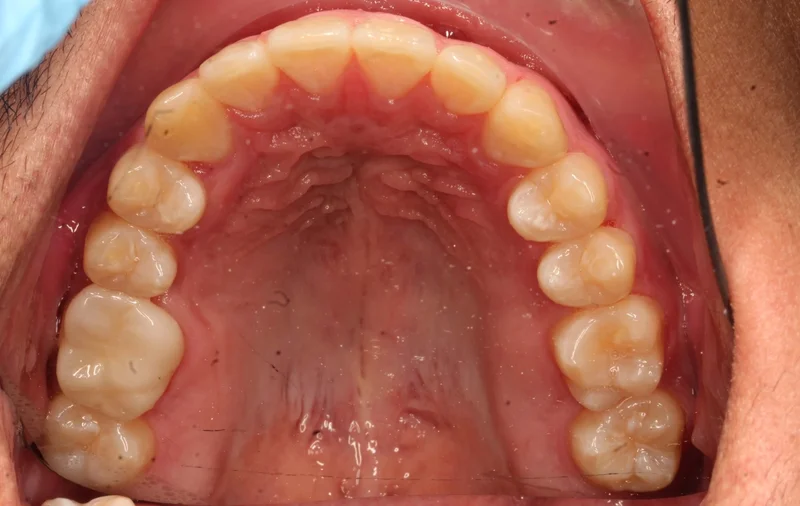 Upper Occlusal - After Treatment