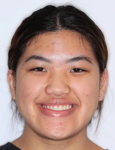 Before Metal Braces treatment - Case 90850