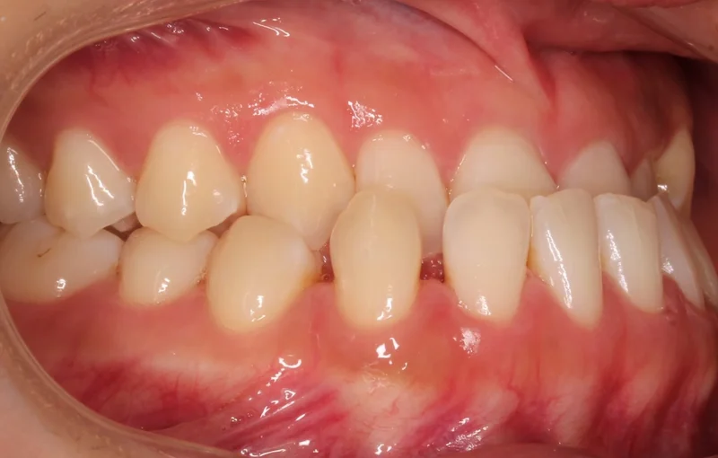 Right Buccal - Before Treatment
