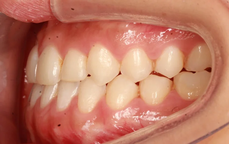 Left Buccal - After Treatment