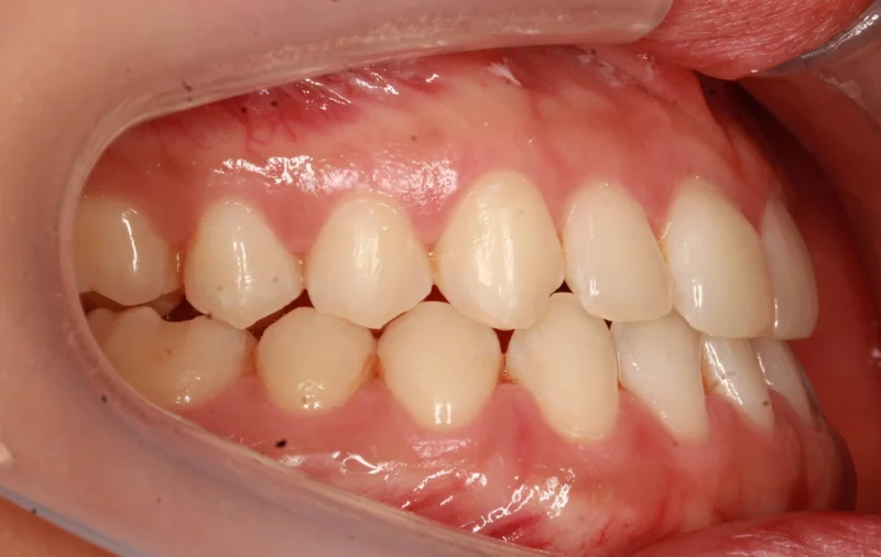 Right Buccal - After Treatment