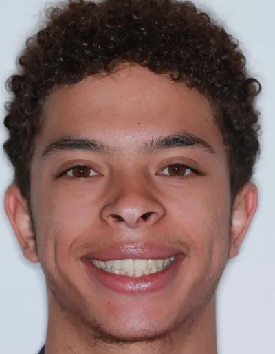 Before Metal Braces treatment - Case 91890