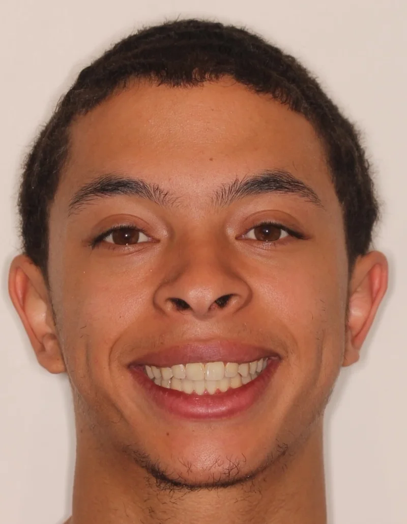 Facial Frontal Smiling - After Treatment