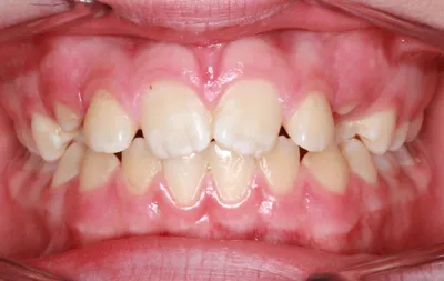 Before Metal Braces treatment - Case 91892
