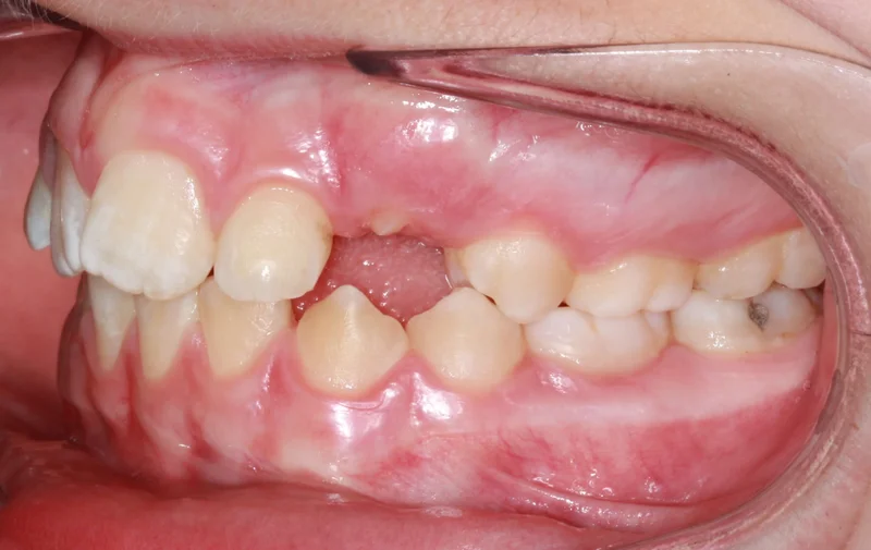 Left Buccal - Before Treatment