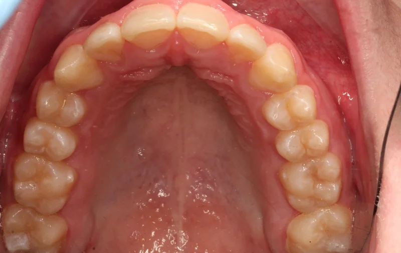 Upper Occlusal - After Treatment