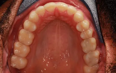 After Metal Braces treatment - Case 91937
