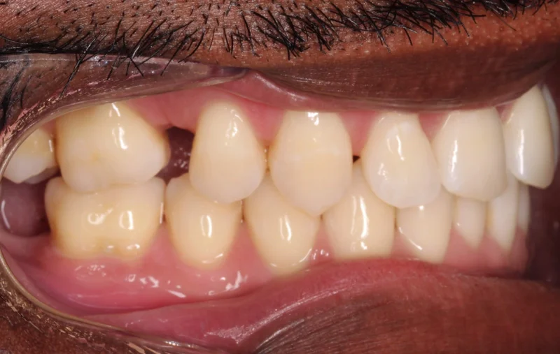 Right Buccal - Before Treatment