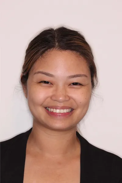 Before Metal Braces treatment - Case 92665