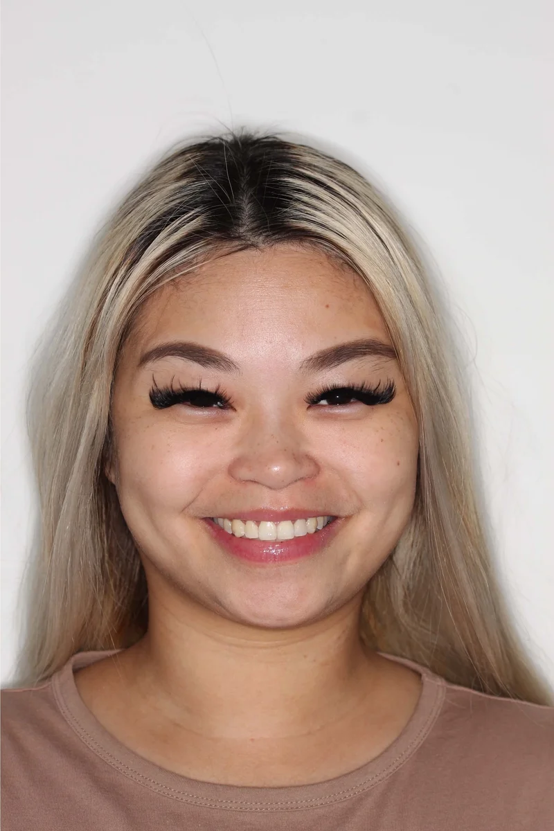 Front Facial Smiling - After Treatment