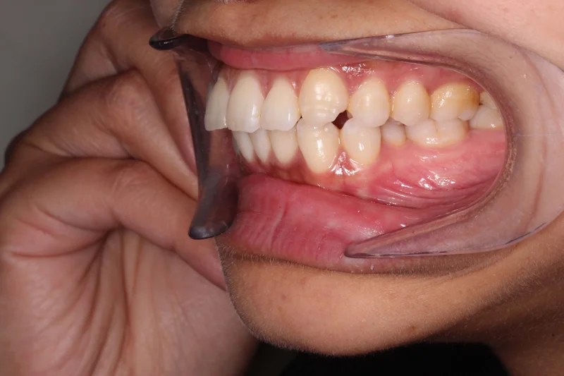 Left Buccal - Before Treatment