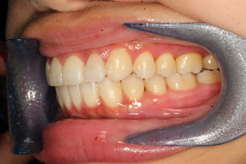 Left Buccal - After Treatment