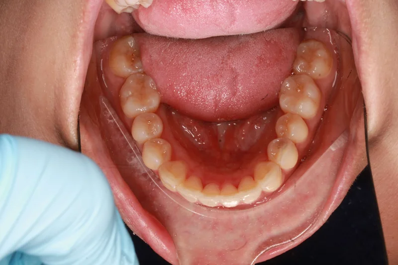 Lower Occlusal - After Treatment