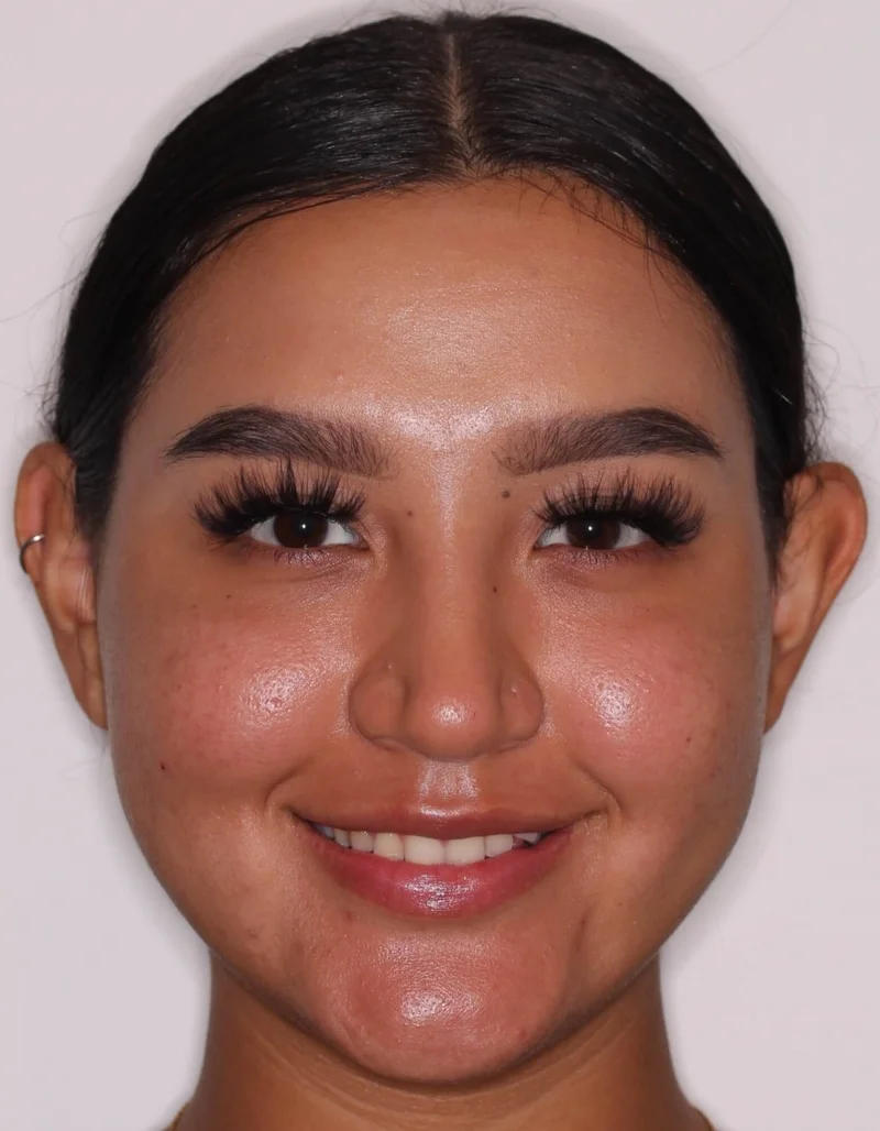 Front Facial Smiling - Before Treatment