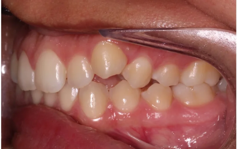 Left - Before Treatment