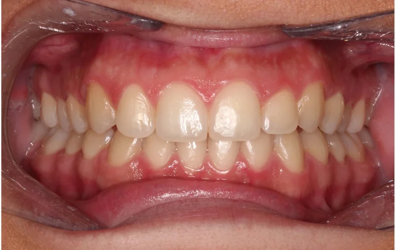 Center - After Treatment