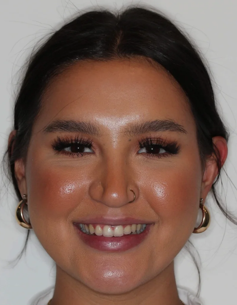 Front Facial Smiling - After Treatment