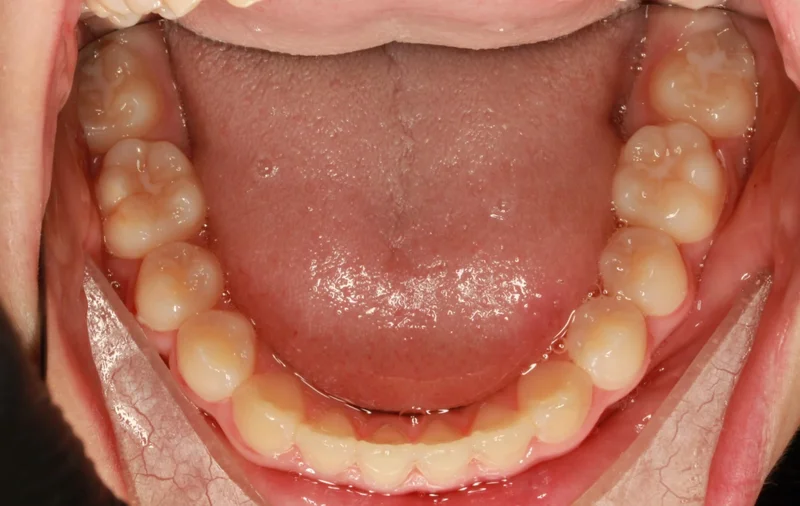 Lower Occlusal - After Treatment