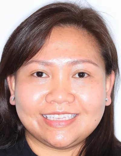 Before Metal Braces treatment - Case 95767
