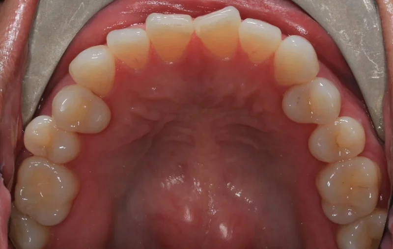 Upper - Before Treatment