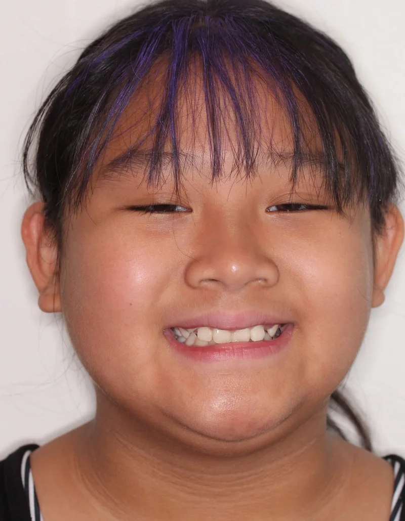 Front Facial Smiling - Before Treatment