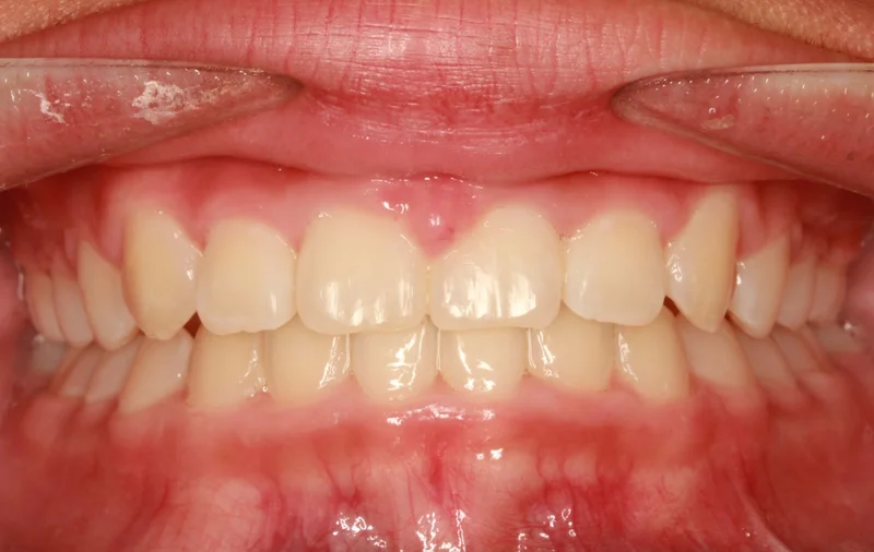Center - After Treatment
