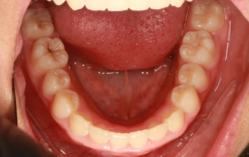 Lower - After Treatment