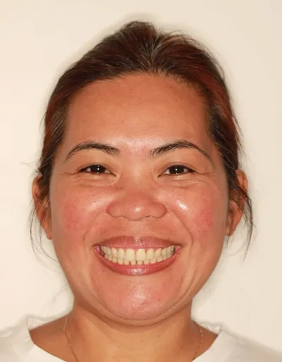 After Metal Braces treatment - Case 98157