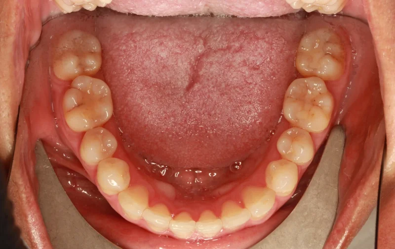 Lower - After Treatment