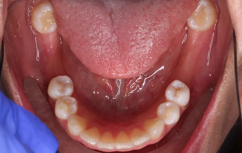 Lower - Before Treatment